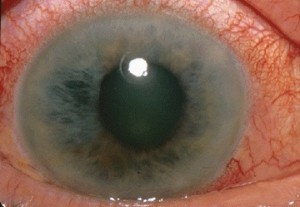 glaucoma